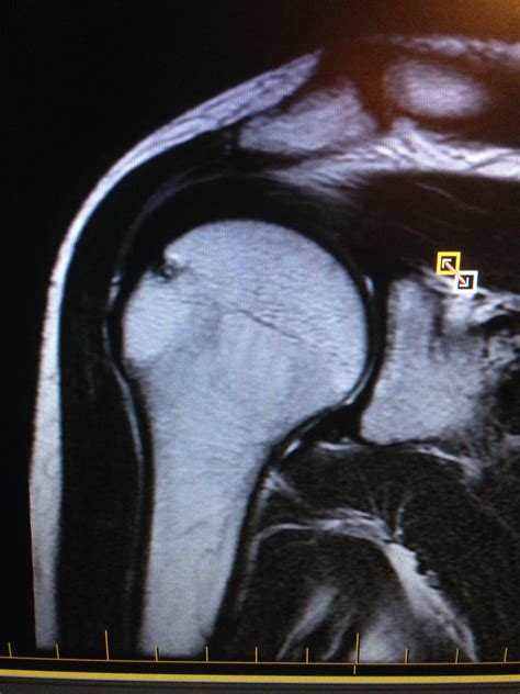 Right Shoulder Mri 33f Shoulder Dislocation 05cm Hole Radiology
