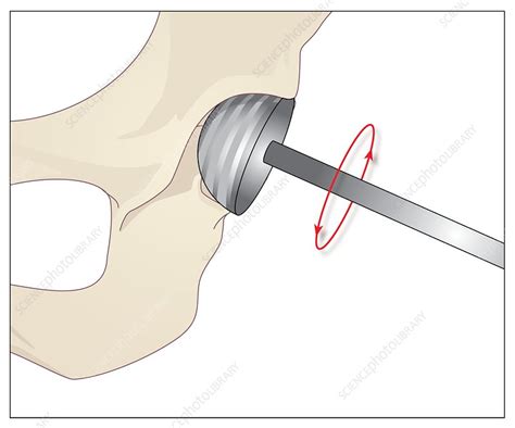Hip Replacement Artwork Stock Image C008 5305 Science Photo Library