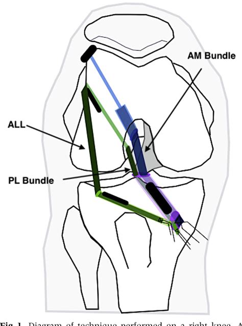 Figure 1 From Combined Double Bundle Anterior Cruciate Ligament Reconstruction And Anterolateral
