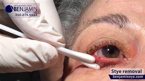 A Quick And Effective Stye Removal In Office Procedure Youtube
