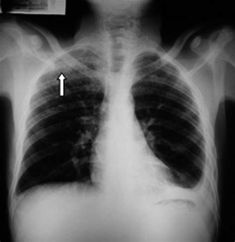 Postero Anterior Chest X Ray Showing Pulmonary Infiltrate In The Apex