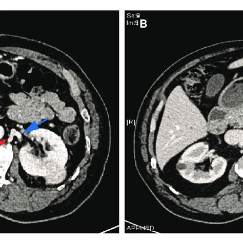 Perioperative Computed Tomography Ct Scans From Two Patients With