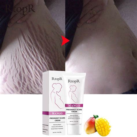 Stretch Mark Cream Pregnancy Repair Scar Line Abdomen Stretch Marks Cream New Ebay