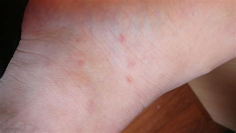 19m Random Red Spots Appearing On My Foot These Few Days Slightky
