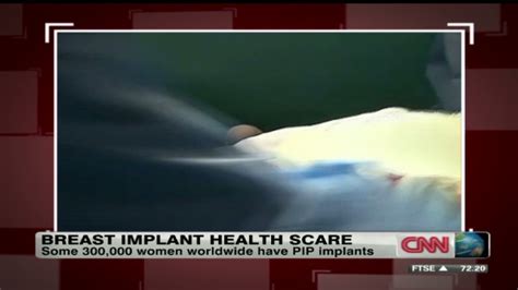Breast Implant Scandal What Went Wrong Cnn