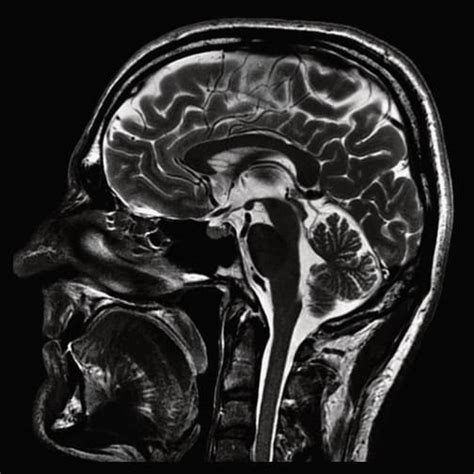 Brain Mri Insight Medical Imaging