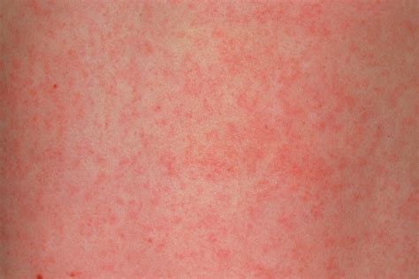 German Measles As Related To Rubella Pictures