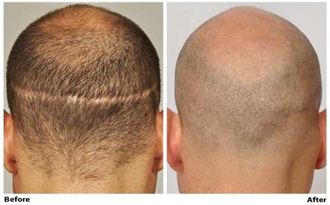 Patient Ssp A Complete Strip Scar Camouflage Forhairdr Cole