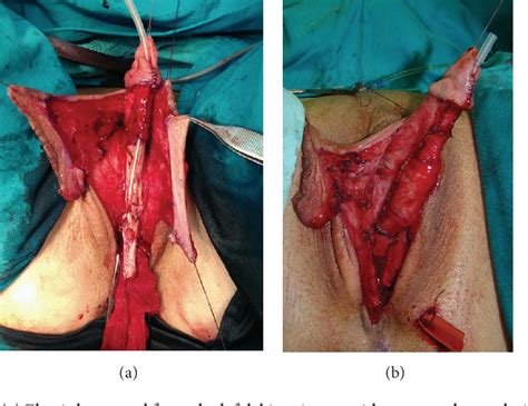 Figure From The Role Of Clitoral Anatomy In Female To Male Sex Reassignment Surgery Semantic