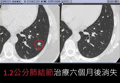 胸腔重症蘇一峰醫師 怕！發現了數顆肺結節！除了追蹤等待和切片開刀之外，還能做什麼嗎？