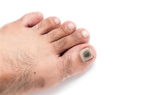 5 Vzroki za nohte na nogah Spreminjanje v črno barvo