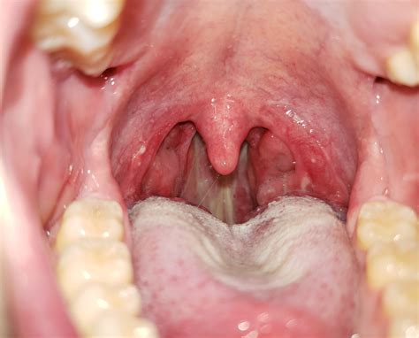 White Bump On Tonsil