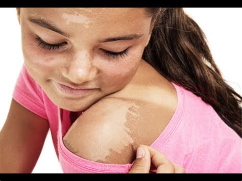 How to treat a sunburn. How to Get Rid of Peeling Skin after Sunburn - Sunburn ...