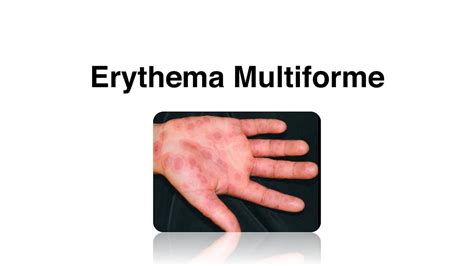 Erythema Multiforme Causes Complications And Treatment Youtube