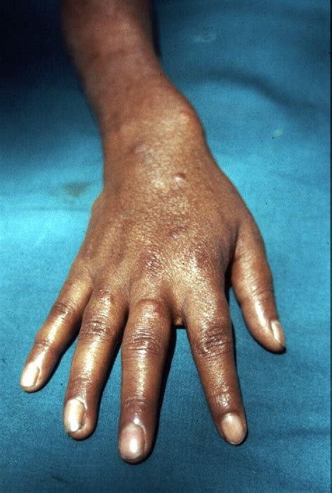 Leprosy Clinics In Dermatology