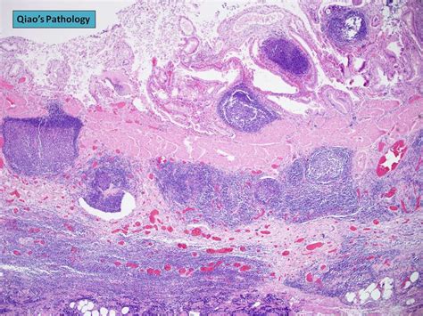 Pathology Outlines Eosinophilic Cholecystitis