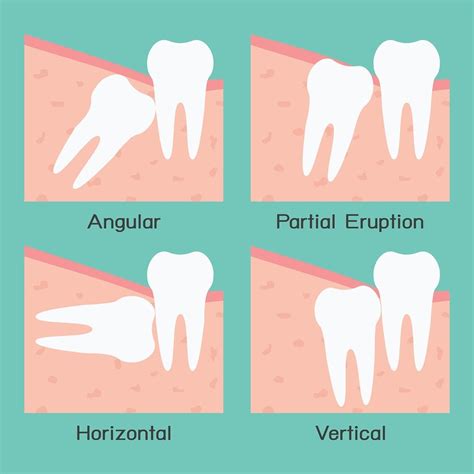 Wisdom Tooth Extractions Everything You Need To Know • Health Blog