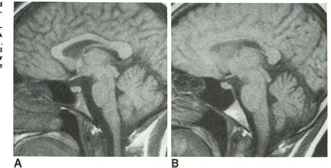 Figure 1 From Mr Imaging Of The Normal And Abnormal Clivus Semantic