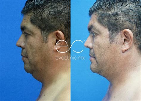 Chin Implant Before And After Evoclinic