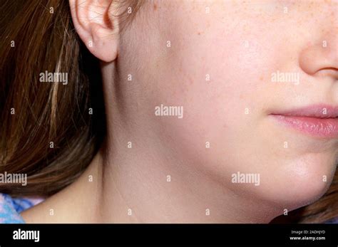 Mumps Swollen Glands In The Cheek Of A 22 Year Old Woman Who Has Mumps