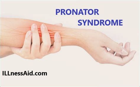 Pronator Syndrome Cause Examination And Treatment Illnessaid