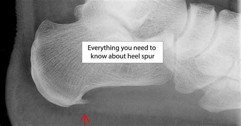 Heel Spur Cause Symptoms Diagosis Treatment And More