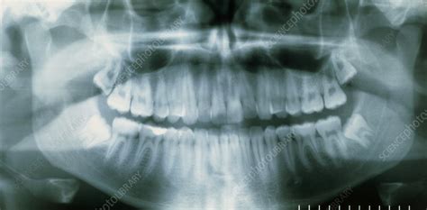 Panoramic Dental X Ray Of Impacted Wisdom Teeth Stock Image M782