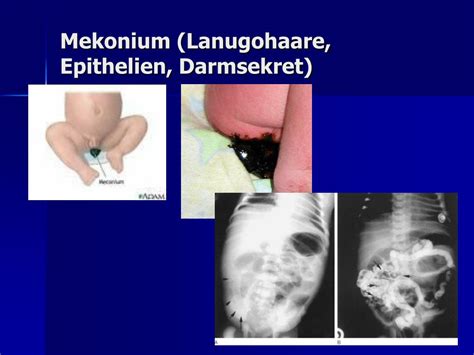Es handelt sich dabei um einen bluterguss (hämatom) zwischen. PPT - Krankheiten der Neugeborenen PowerPoint Presentation ...