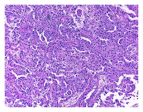 Isolated Axillary Lymph Node Metastasis From Serous Ovarian Cancer
