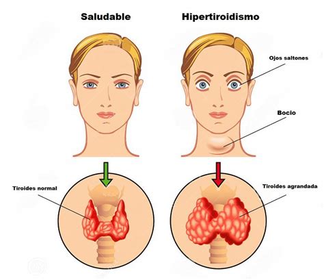 Hipotiroidismo E Hipertiroidismo Aprende Sus Diferencias Signos