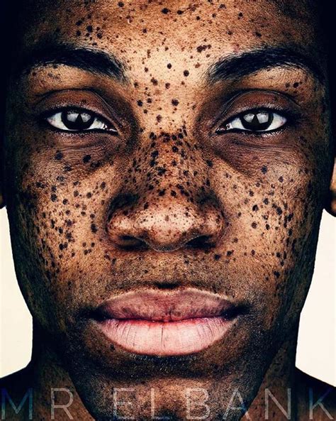 Striking Portraits Of Freckled People By British Photographer
