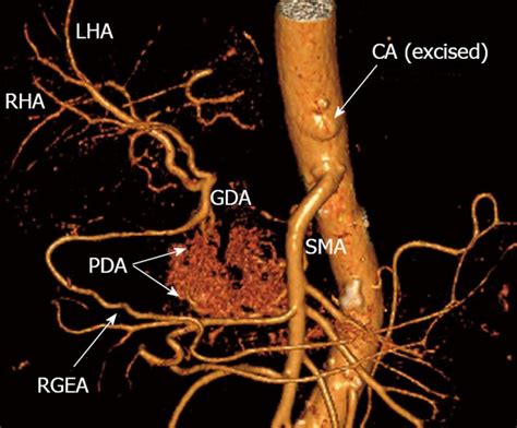 Radiology Anatomy Images Celiac Artery And Its Branches 3d Ct Anatomy