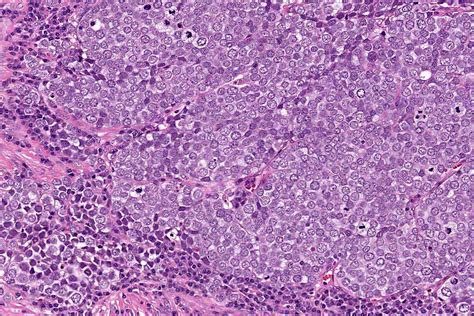 9 Merkel Cell Carcinoma Vulva Plasma Cells Images Cour Flickr