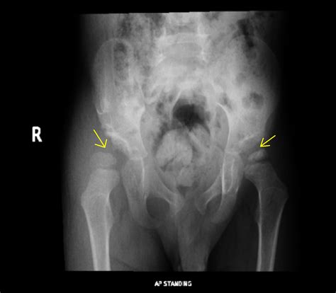Cureus Developmental Dysplasia Of The Hip With Concurrent Legg Calvé