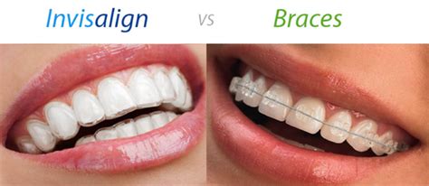 There are also a range of orthodontic treatments which are possible to have which do not have invisible braces. CHOW DENTAL GROUP | Dr. David Chow Mississauga-Brampton ...