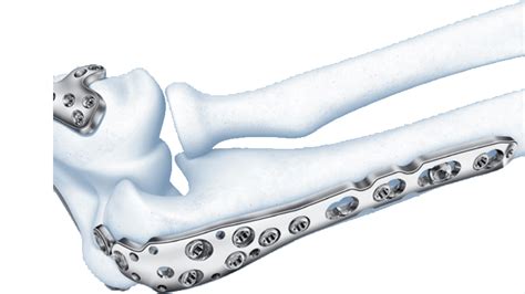 35 Mm Lcp™ Olecranon Plate Products Depuy Synthes