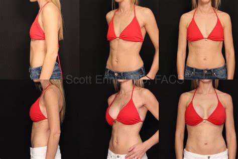 What To Expect After Breast Augmentation Core Plastic Surgery