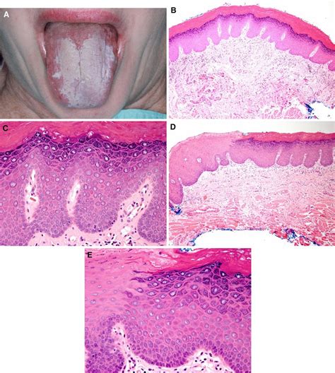 Case 5 A Unifocal Fissured Homogenous Leukoplakia On The Dorsal Tongue