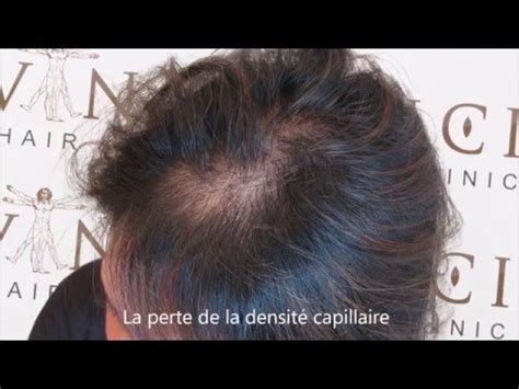 La chute de cheveux est source d'inquiétude chez la femme comme chez l'homme. La Perte de Cheveux chez les Femmes et la Pigmentation du Cuir Chevelu - Vinci Hair Clinic - YouTube