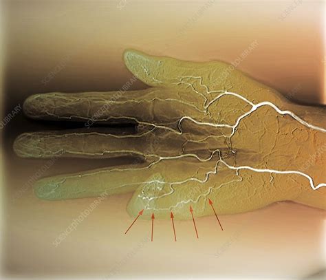 Blood Supply Of The Hand Angiogram Stock Image C0180387 Science