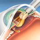 Photos of Refractive Lens Exchange Rle