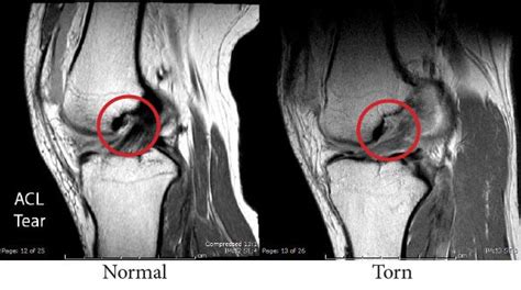 Pcl is abnormally thickened with intermediate signal. Images of What a Musculoskeletal Radiologist Sees | ARA