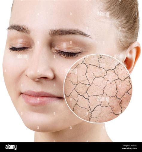Zoom Circle Shows Dry Facial Skin Before Moistening Stock Photo Alamy