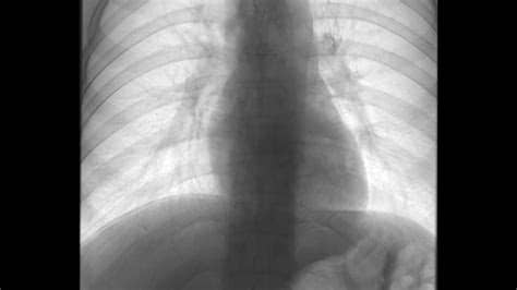 Aortic aneurysm fact sheet. mayo clinic: Heart X-ray - YouTube