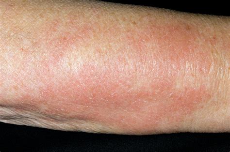 Allergic Rash Photograph By Dr P Marazziscience Photo Library