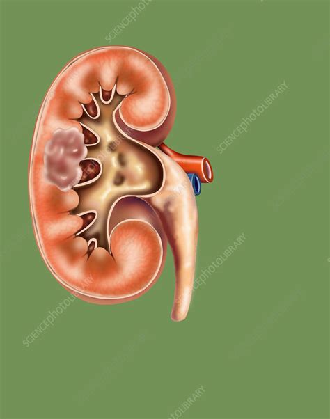 Kidney Cancer Stock Image F0316945 Science Photo Library