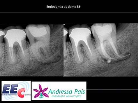 EQUIPE DE ENDODONTIA DE CAMPINAS Tratamento Endodôntico do dente Profa Andressa Pais