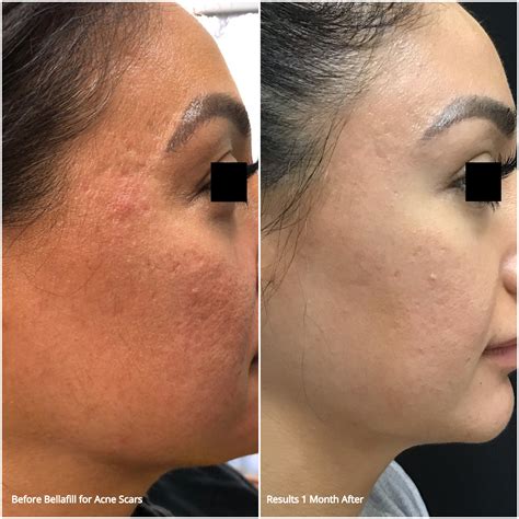 Acne Scar Revision Usha Rajagopal Md