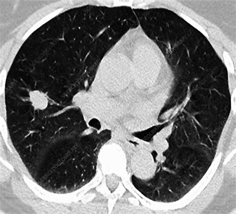 Early Lung Cancer Ct Scan