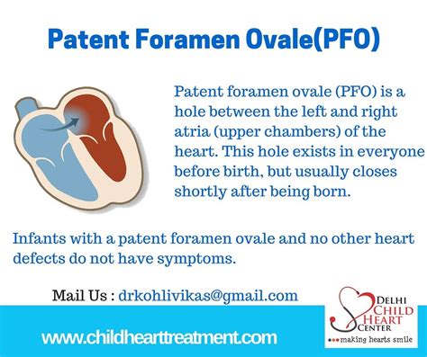 Patent Foramen Ovale Pfo Is A Hole Between The Left And Right Atria